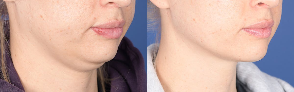Necklift Before & After Gallery - Patient 193996 - Image 5