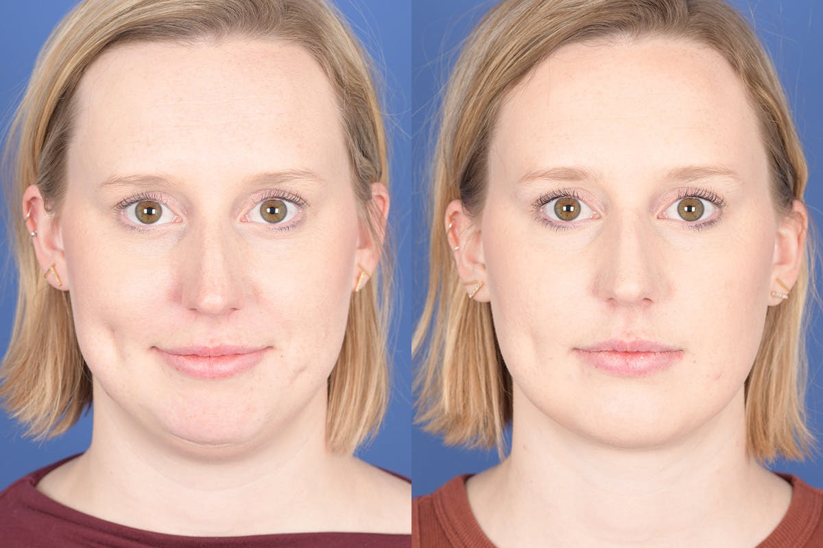 Necklift Before & After Gallery - Patient 266763 - Image 1