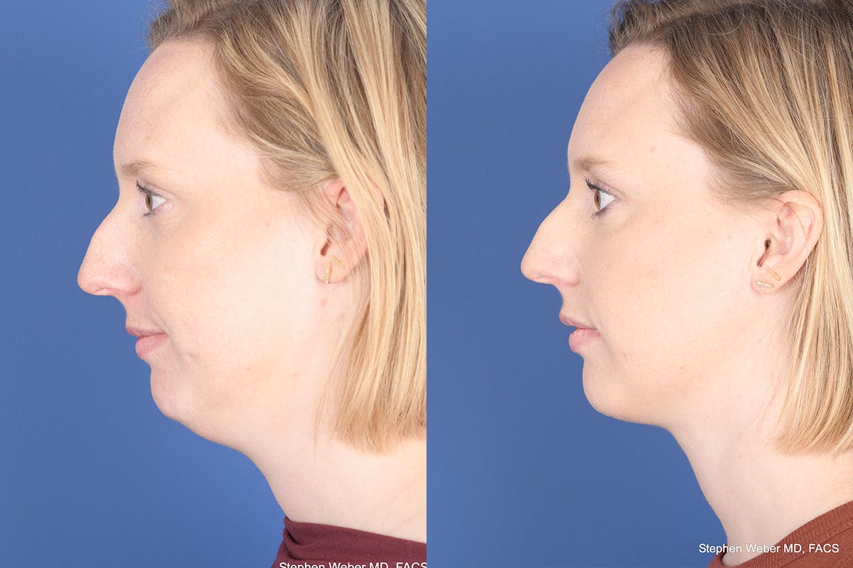 Necklift Before & After Gallery - Patient 266763 - Image 2