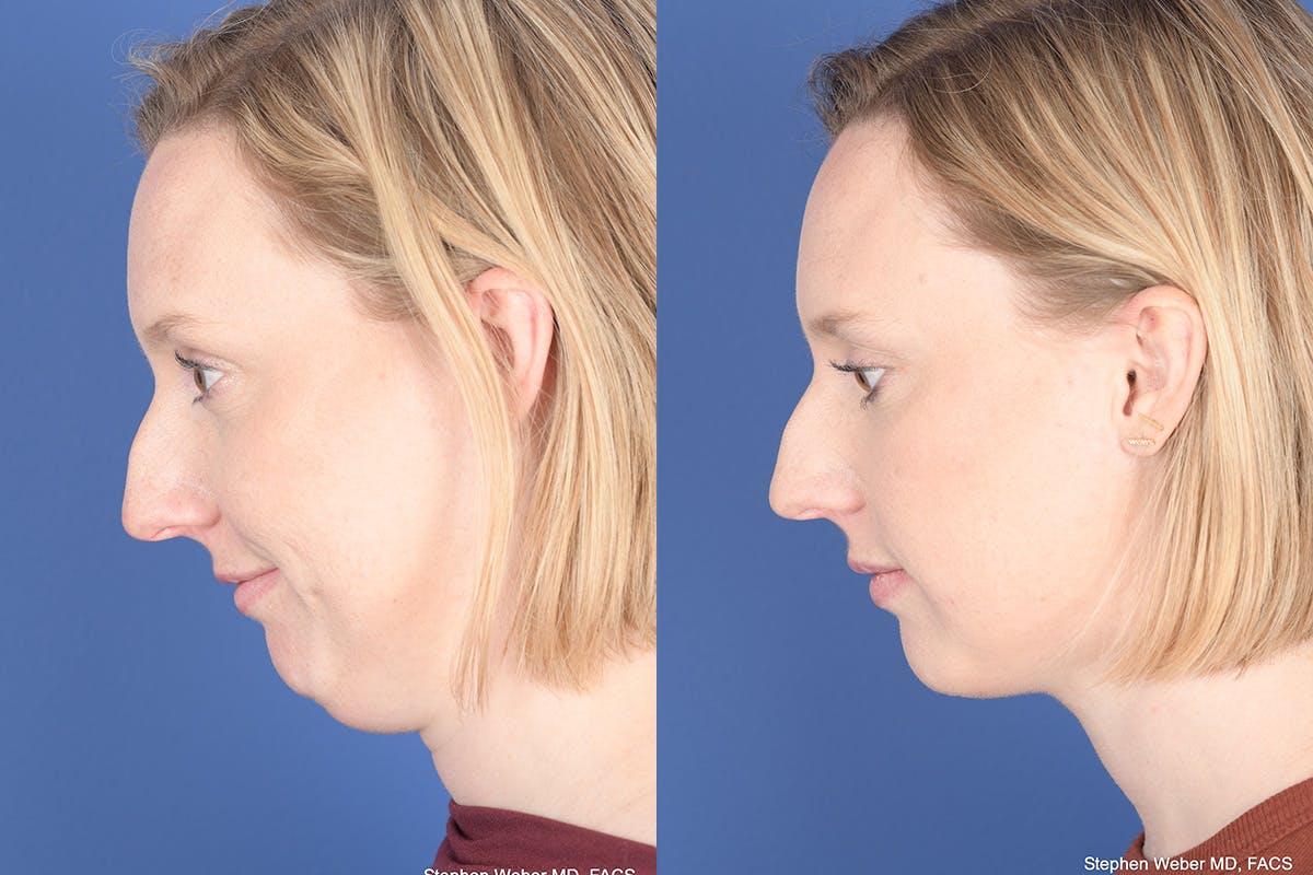 Necklift Before & After Gallery - Patient 266763 - Image 3