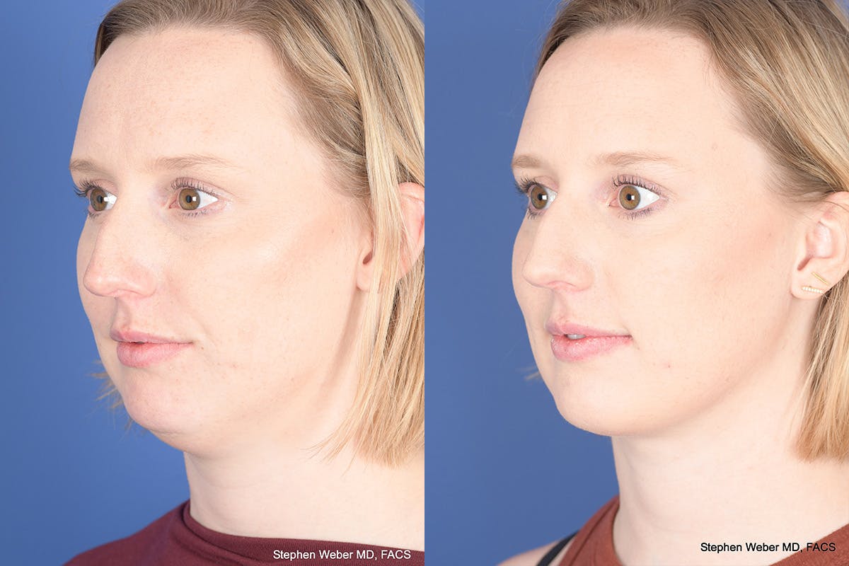 Necklift Before & After Gallery - Patient 266763 - Image 4