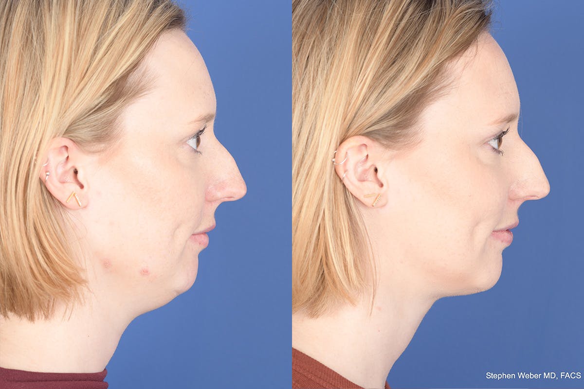 Necklift Before & After Gallery - Patient 266763 - Image 5
