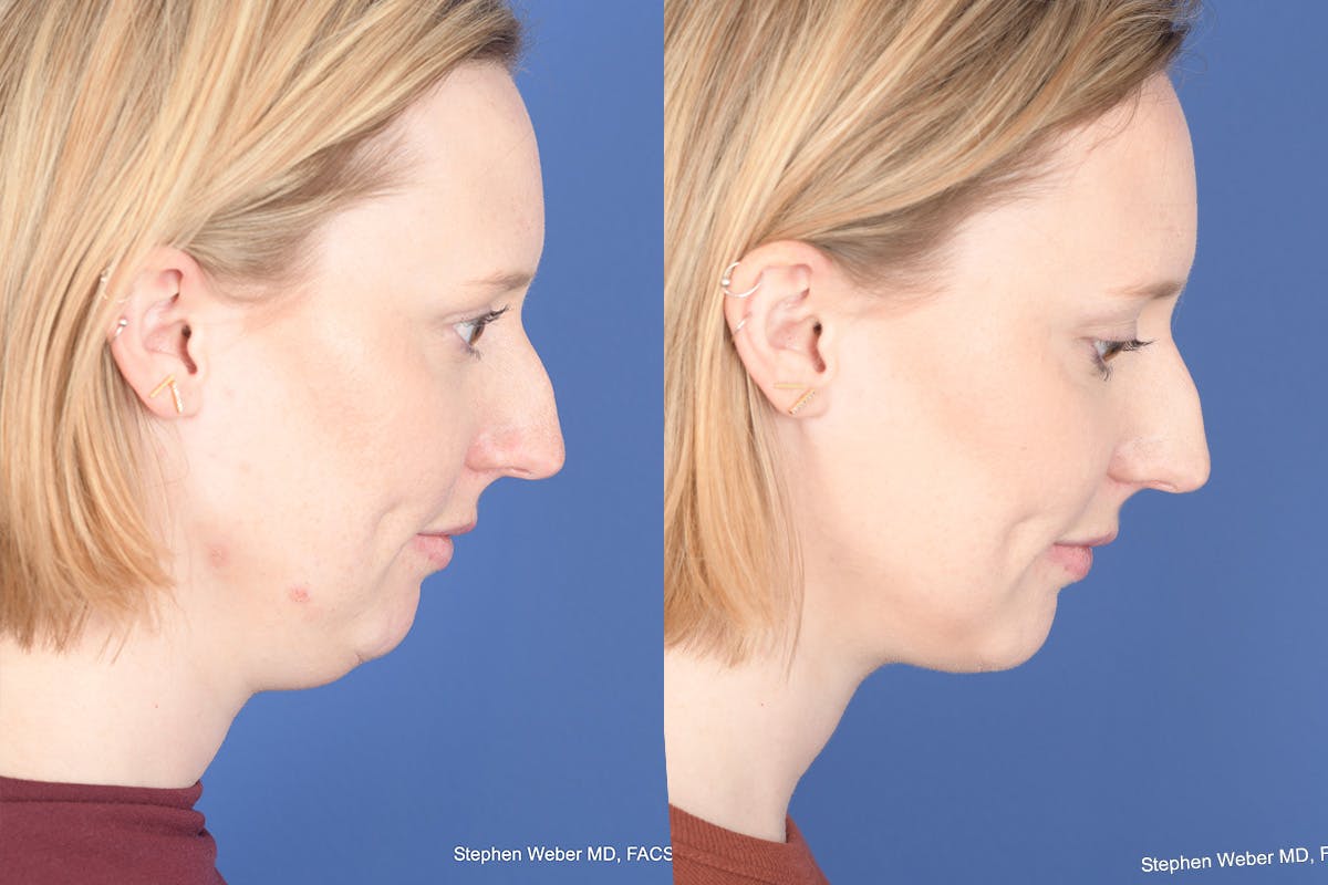 Necklift Before & After Gallery - Patient 266763 - Image 6