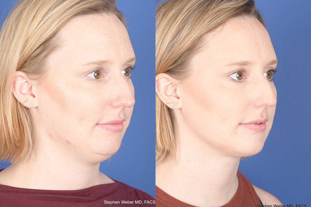 Necklift Before & After Gallery - Patient 266763 - Image 7