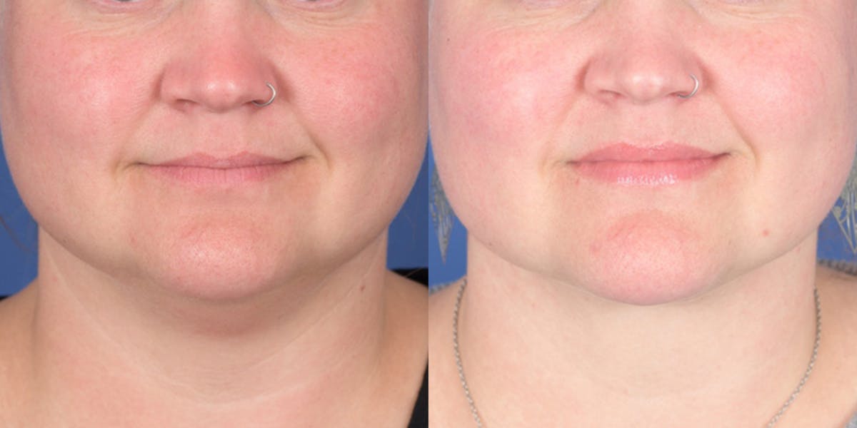 Necklift Before & After Gallery - Patient 298810 - Image 1