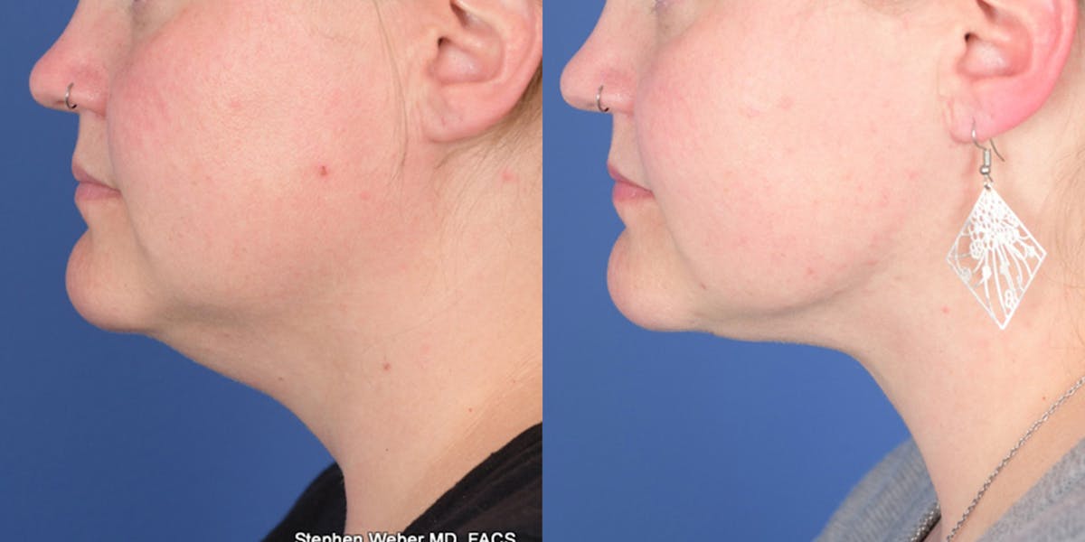 Necklift Before & After Gallery - Patient 298810 - Image 2