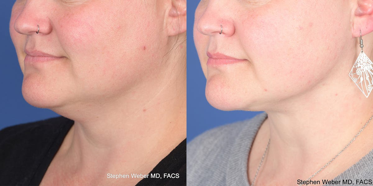Necklift Before & After Gallery - Patient 298810 - Image 3