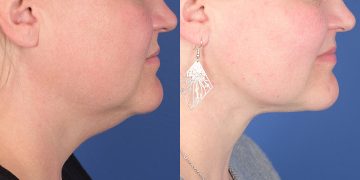 Necklift Before & After Gallery - Patient 298810 - Image 4