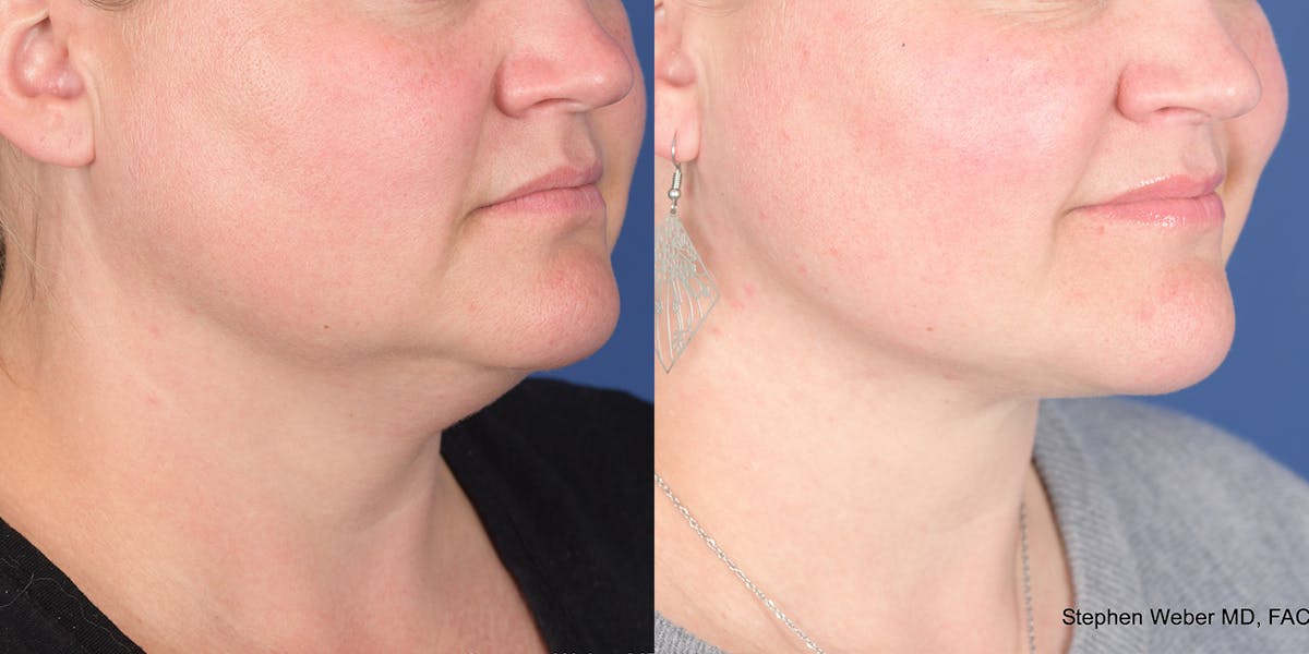 Necklift Before & After Gallery - Patient 298810 - Image 5