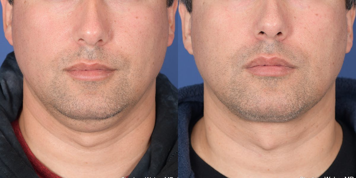 Necklift Before & After Gallery - Patient 627368 - Image 1