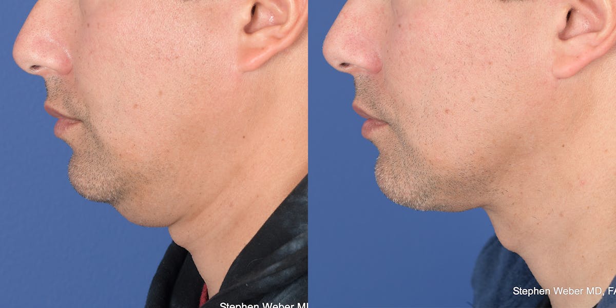 Necklift Before & After Gallery - Patient 627368 - Image 2