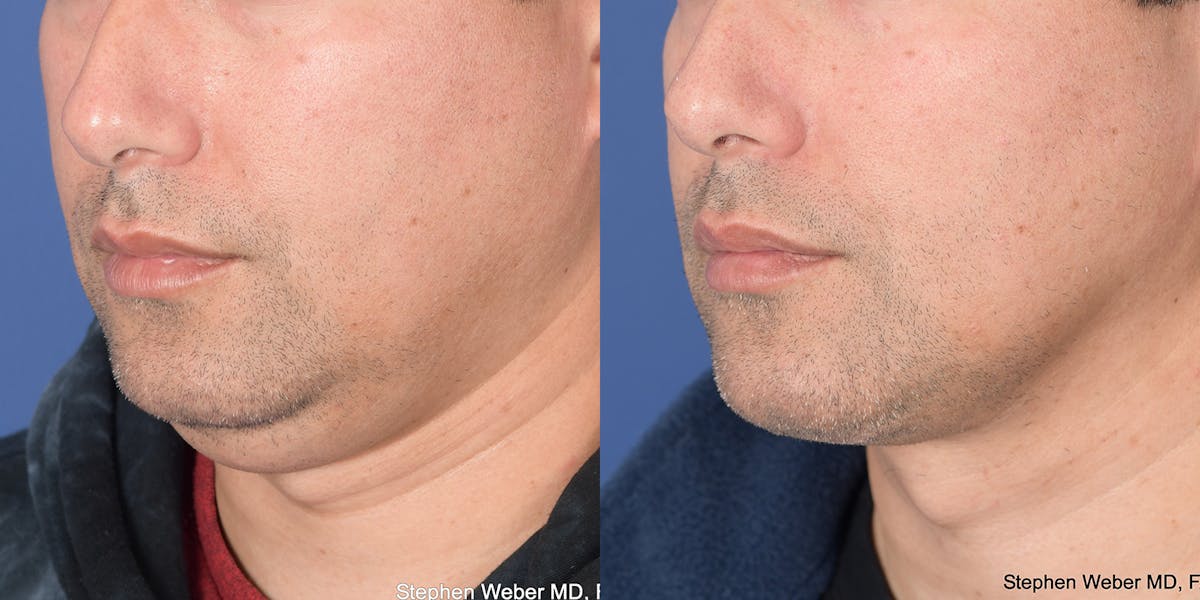 Necklift Before & After Gallery - Patient 627368 - Image 3