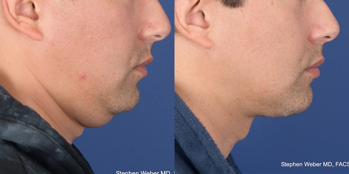 Necklift Before & After Gallery - Patient 627368 - Image 4