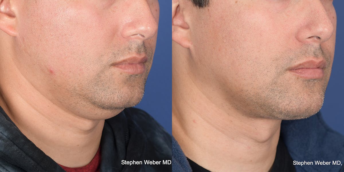Necklift Before & After Gallery - Patient 627368 - Image 5
