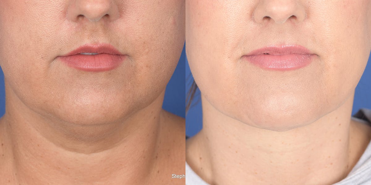 Necklift Before & After Gallery - Patient 764285 - Image 1