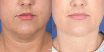 Necklift Before & After Gallery - Patient 764285 - Image 1