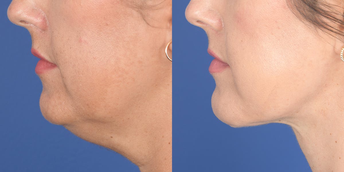 Necklift Before & After Gallery - Patient 764285 - Image 2