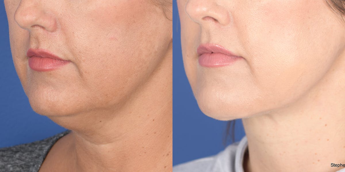 Necklift Before & After Gallery - Patient 764285 - Image 3