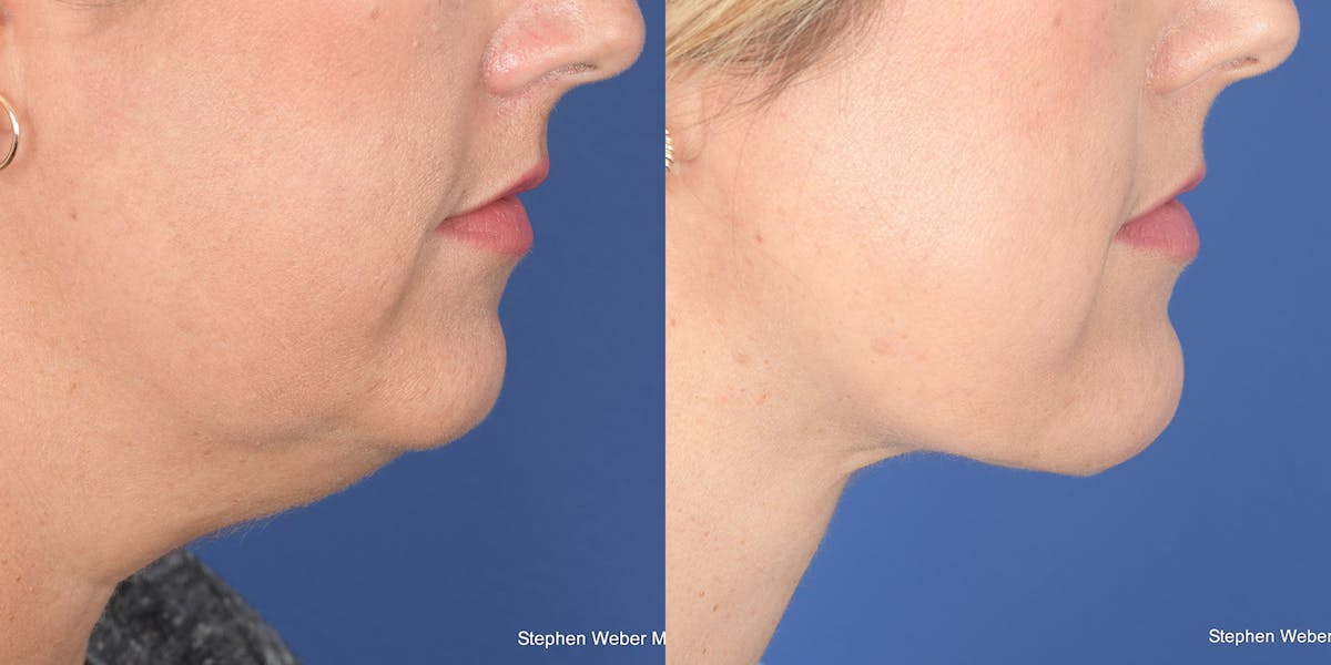 Necklift Before & After Gallery - Patient 764285 - Image 4