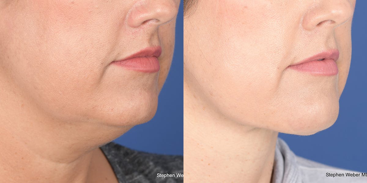 Necklift Before & After Gallery - Patient 764285 - Image 5