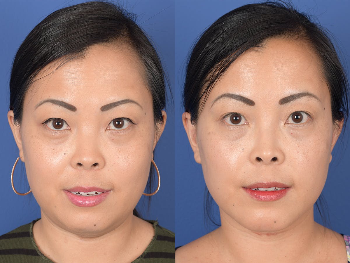 Necklift Before & After Gallery - Patient 102670 - Image 1
