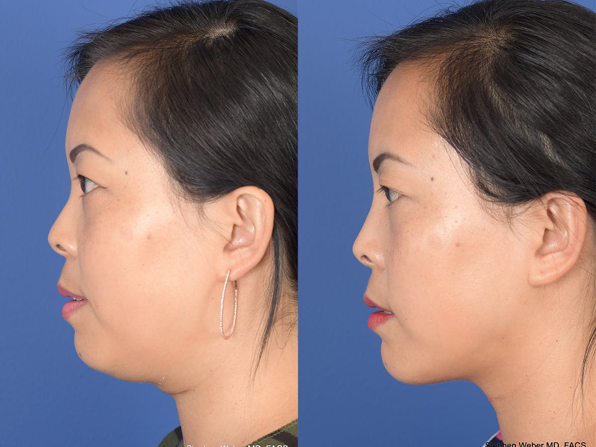Necklift Before & After Gallery - Patient 102670 - Image 2