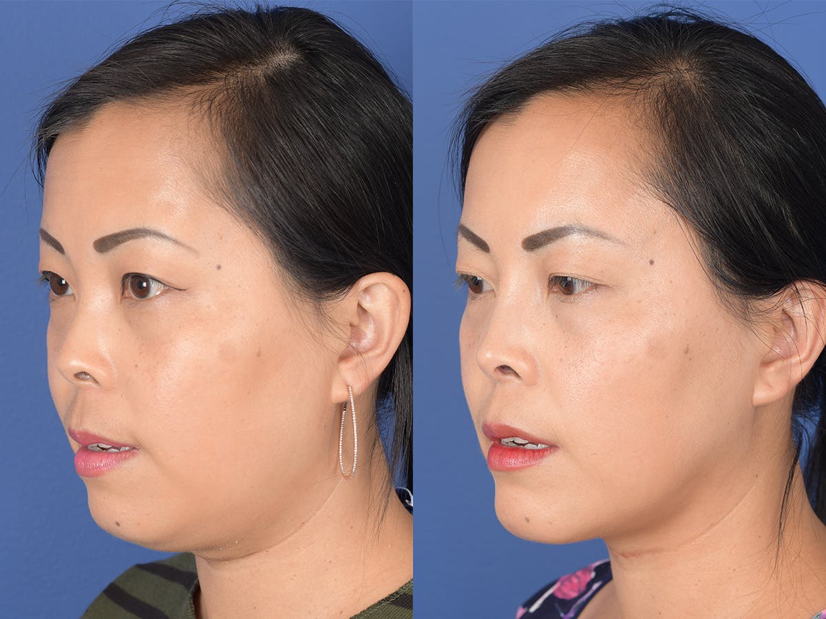 Necklift Before & After Gallery - Patient 102670 - Image 3