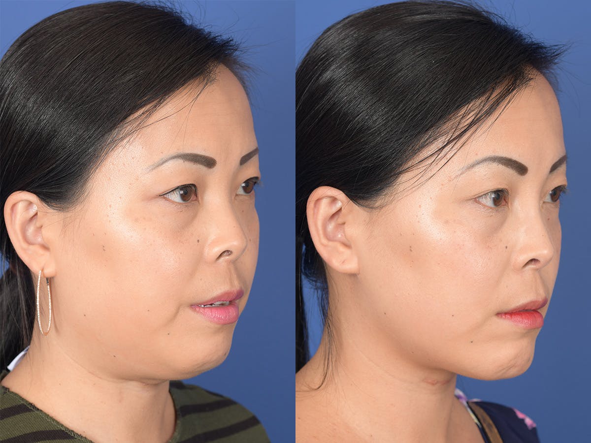 Necklift Before & After Gallery - Patient 102670 - Image 4