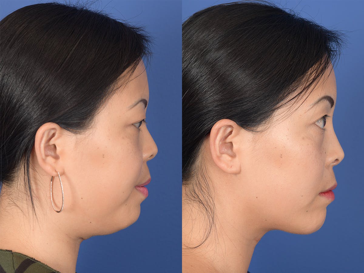 Necklift Before & After Gallery - Patient 102670 - Image 5