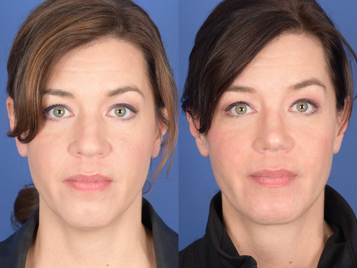 Necklift Before & After Gallery - Patient 353761 - Image 1