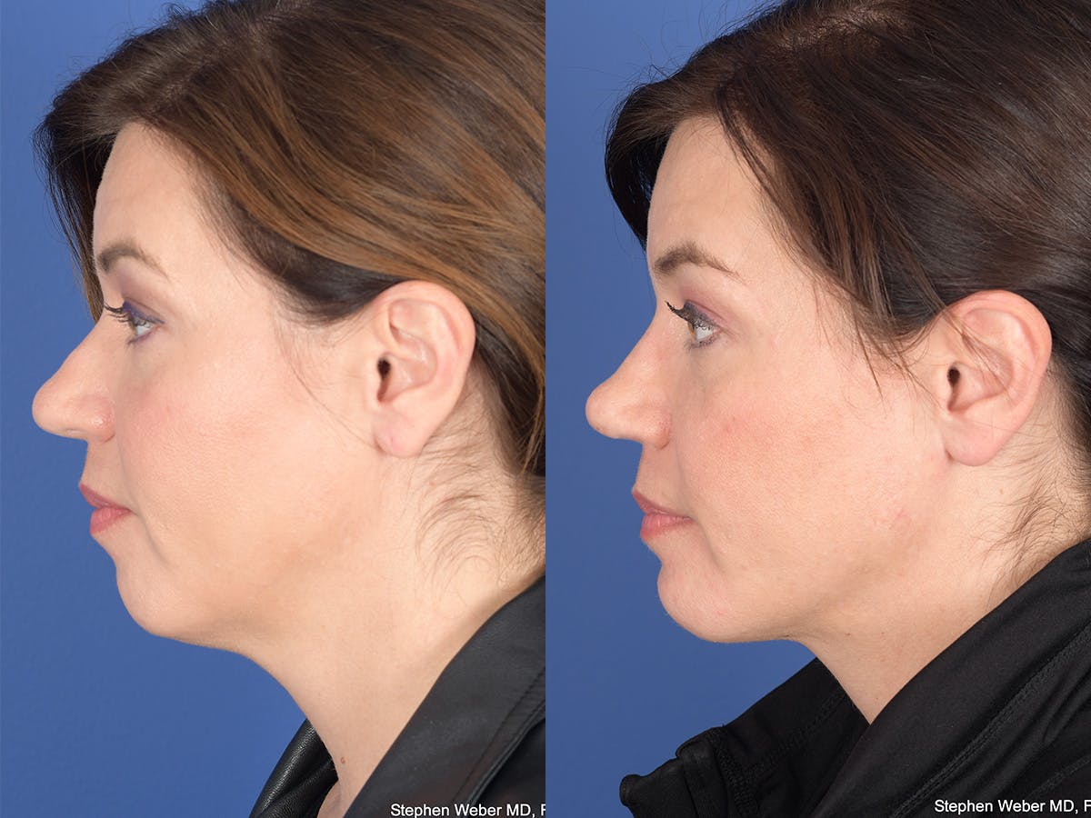 Necklift Before & After Gallery - Patient 353761 - Image 2