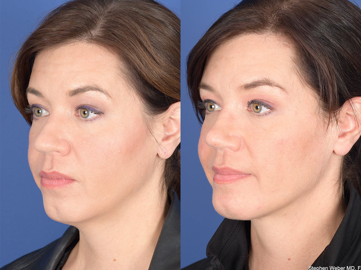 Necklift Before & After Gallery - Patient 353761 - Image 3