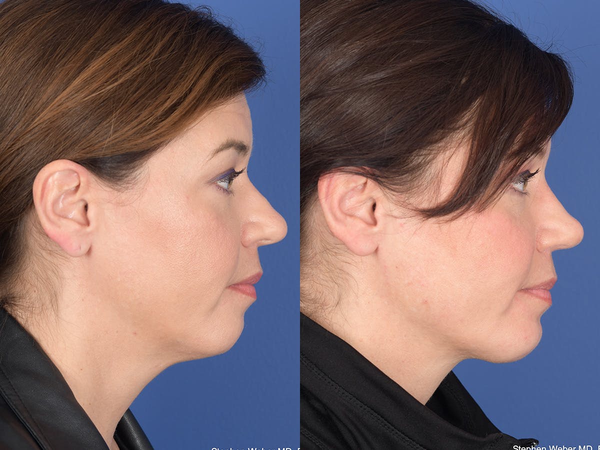 Necklift Before & After Gallery - Patient 353761 - Image 5