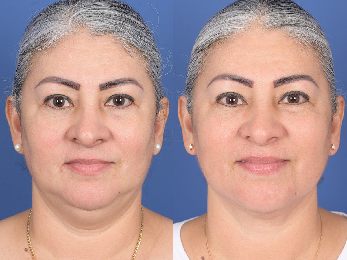 Necklift Before & After Gallery - Patient 219049 - Image 1
