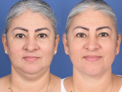 Necklift Before & After Gallery - Patient 219049 - Image 1