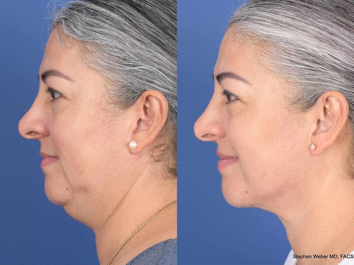 Necklift Before & After Gallery - Patient 219049 - Image 2