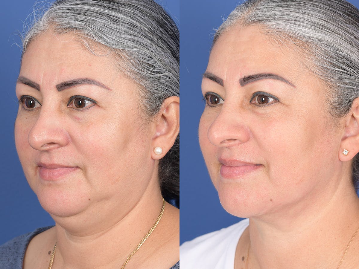 Necklift Before & After Gallery - Patient 219049 - Image 3