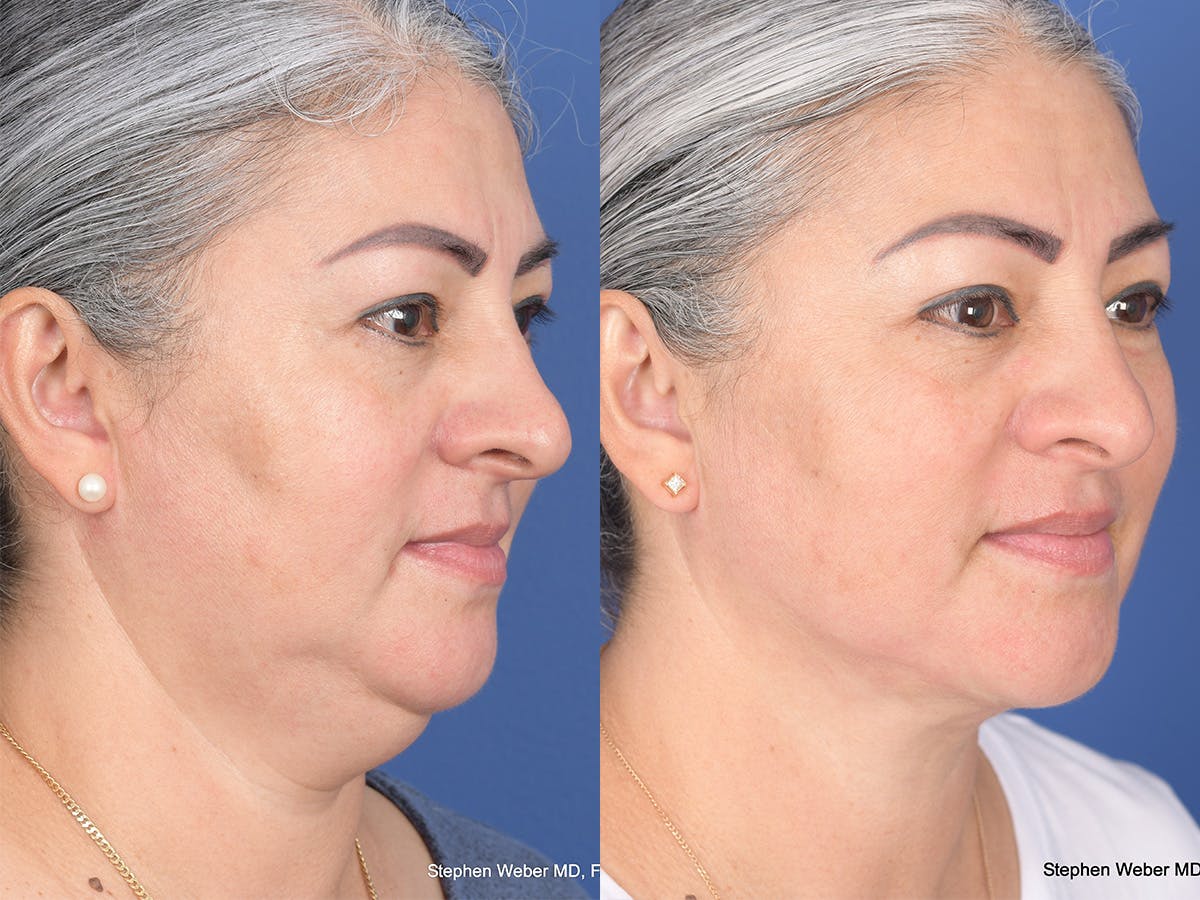 Necklift Before & After Gallery - Patient 219049 - Image 4