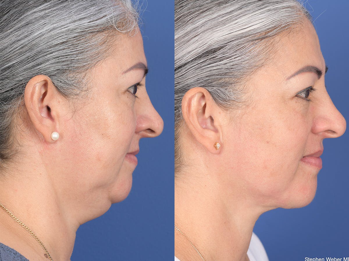 Necklift Before & After Gallery - Patient 219049 - Image 5