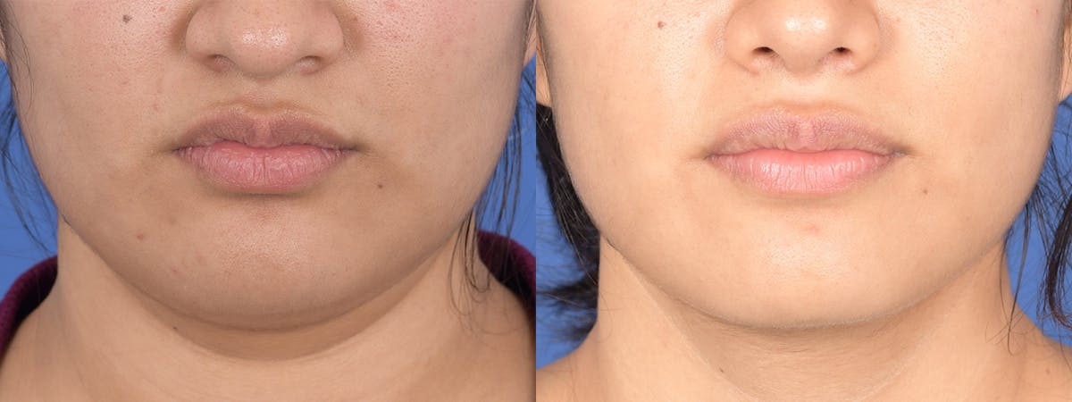 Necklift Before & After Gallery - Patient 235915 - Image 1