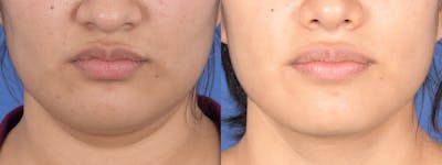 Necklift Before & After Gallery - Patient 235915 - Image 1
