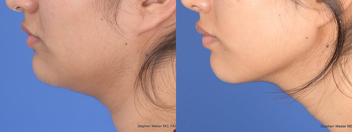 Necklift Before & After Gallery - Patient 235915 - Image 2