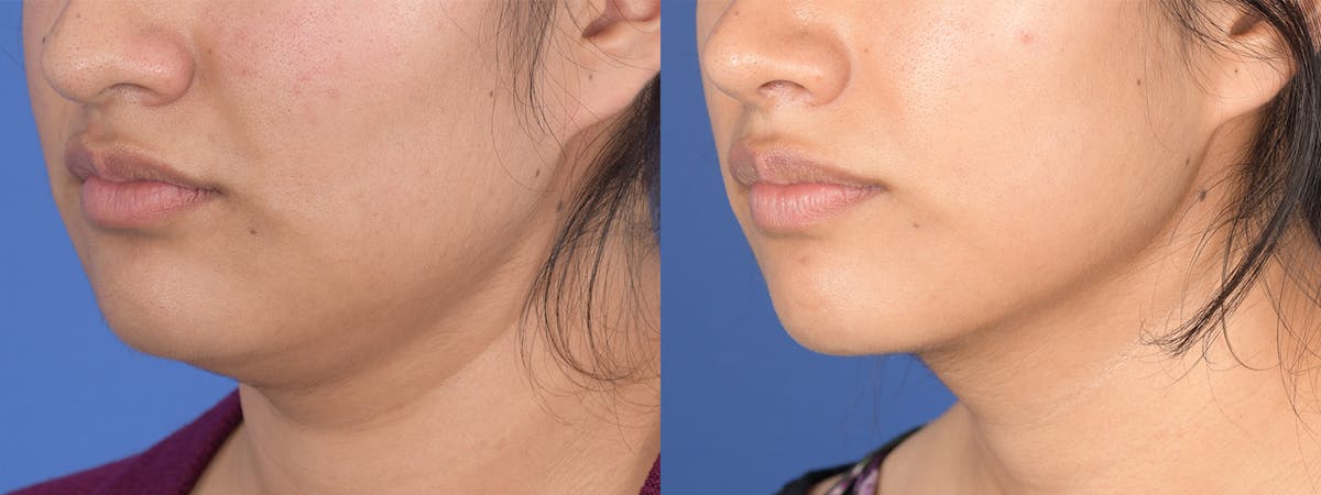 Necklift Before & After Gallery - Patient 235915 - Image 3
