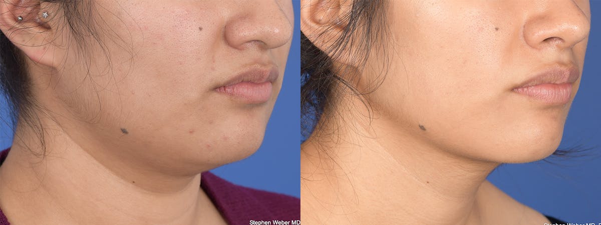 Necklift Before & After Gallery - Patient 235915 - Image 4