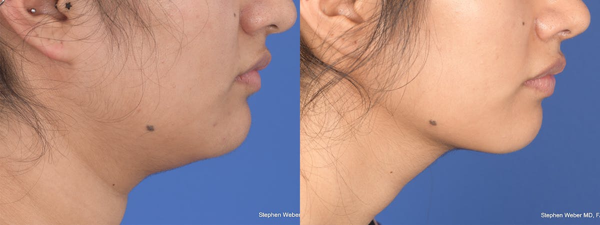Necklift Before & After Gallery - Patient 235915 - Image 5