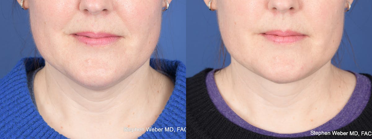 Necklift Before & After Gallery - Patient 210381 - Image 1