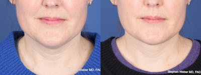 Necklift Before & After Gallery - Patient 210381 - Image 1
