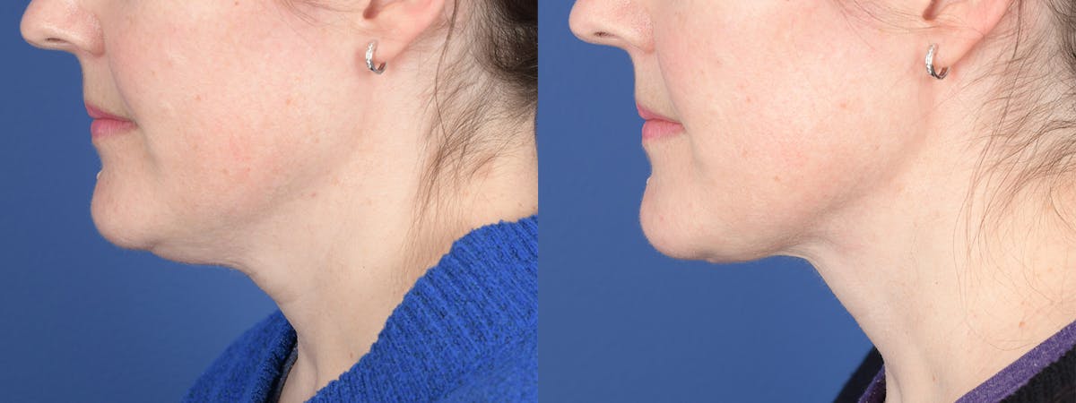 Necklift Before & After Gallery - Patient 210381 - Image 2
