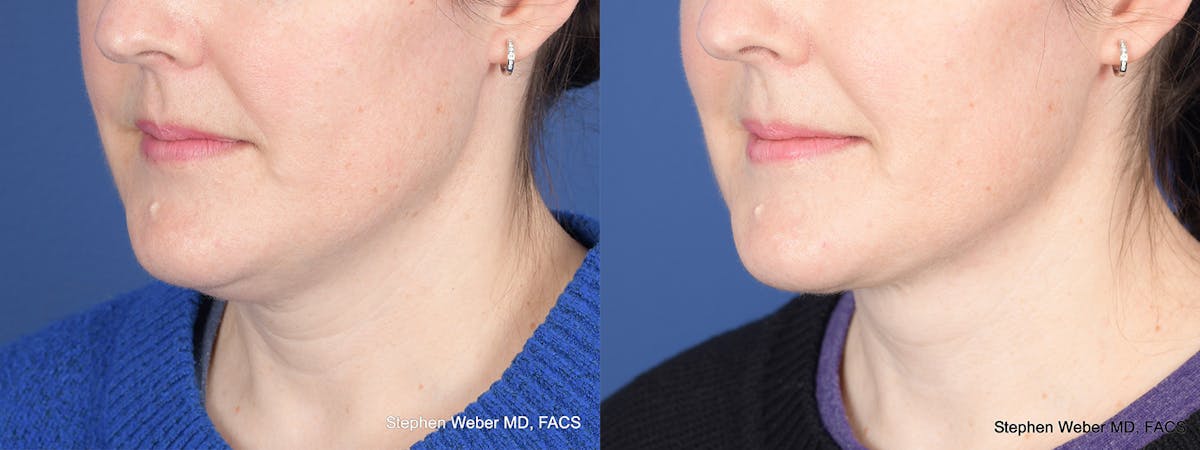 Necklift Before & After Gallery - Patient 210381 - Image 3