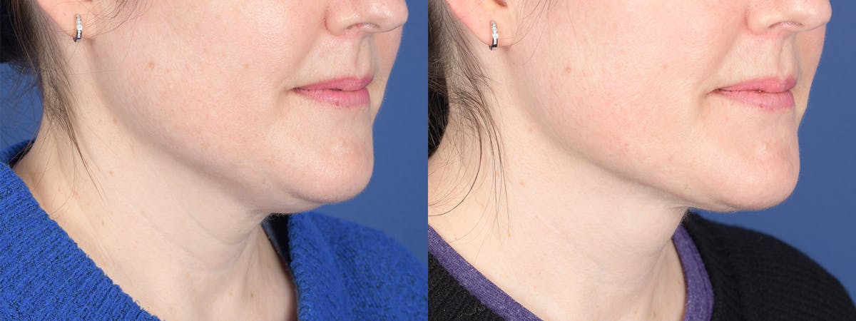 Necklift Before & After Gallery - Patient 210381 - Image 4